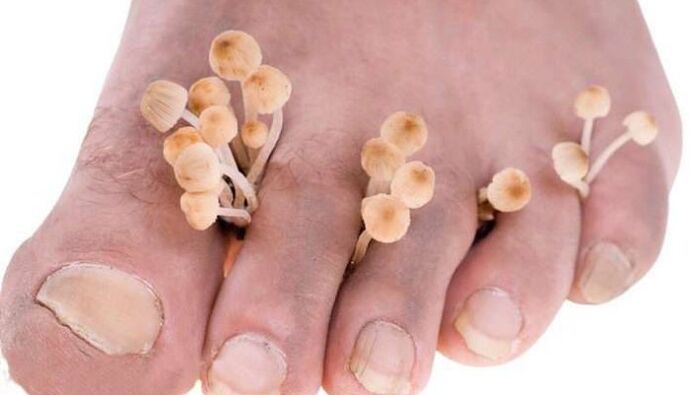 fungus between the toes