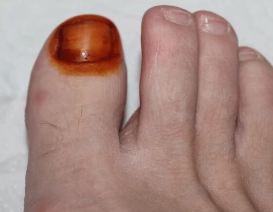 Treatment of the fungus Iodine