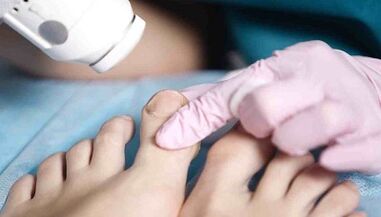 Hardware processing of fungus on feet