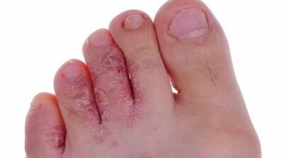 Types and phases of fungus development on their feet