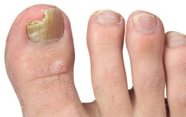 Different forms of fungus