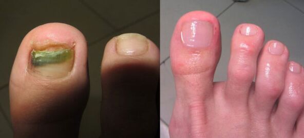 Healing nail fungus