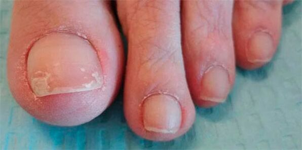 Phases of fungal legs