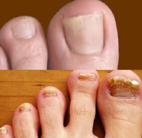 initial and advanced stages of foot fungus