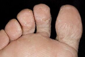 symptoms of foot fungus
