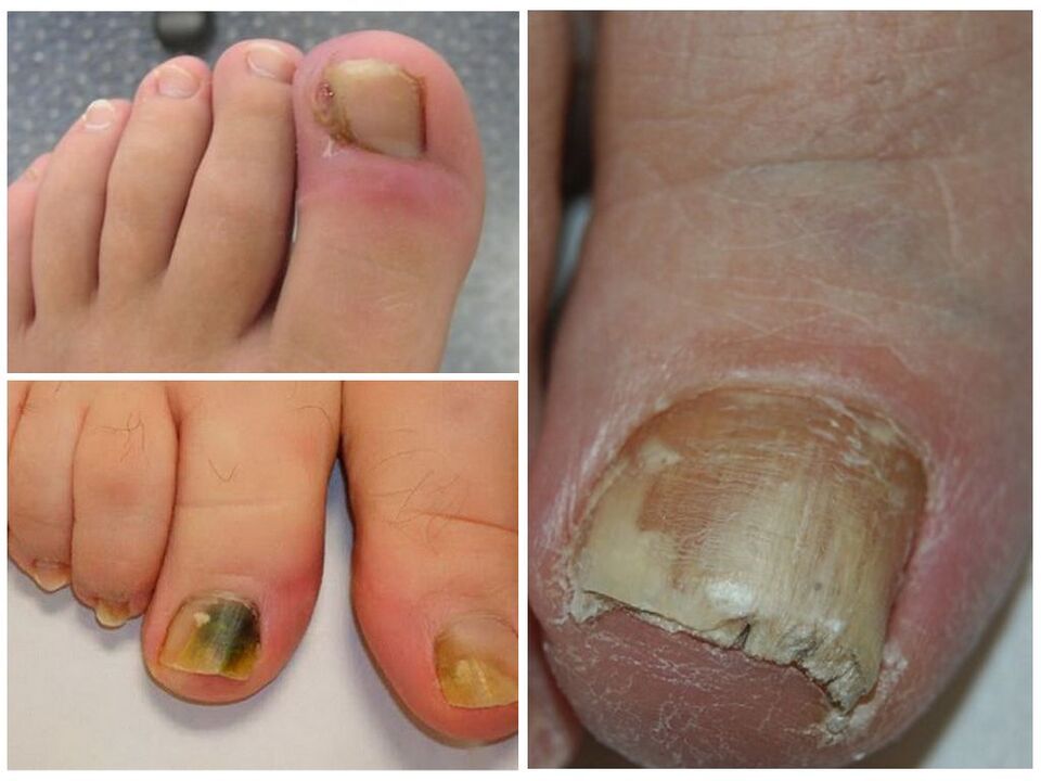 fungal toenail infection