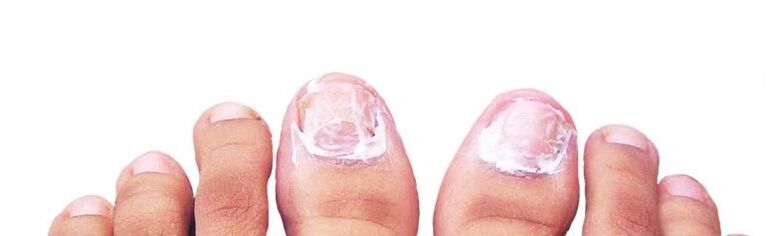 anti-fungal nail ointment