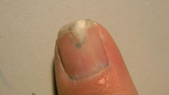 nail fungus symptoms