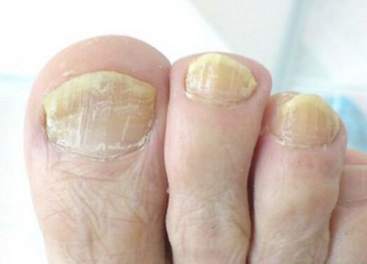 advanced toenail fungus