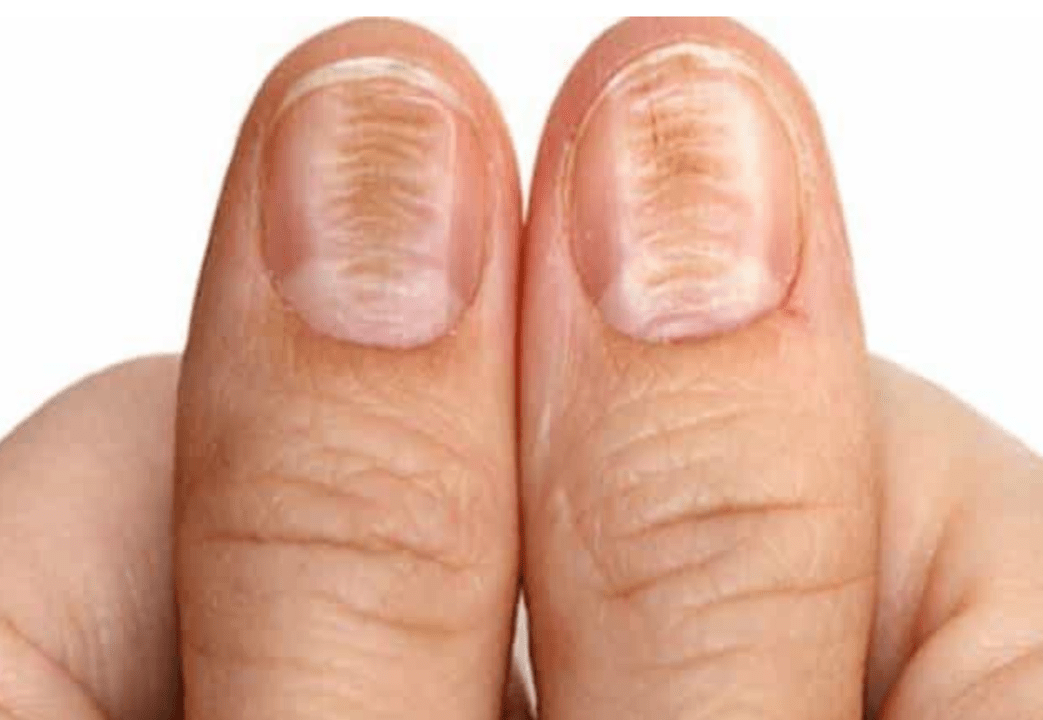 change in color and structure of nails